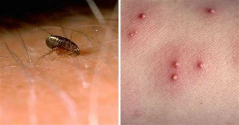 How To Recognize Each One Of These 12 Common Bug Bites Bug Bites