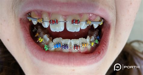 Colored Braces Modern Orthodontics Clinic