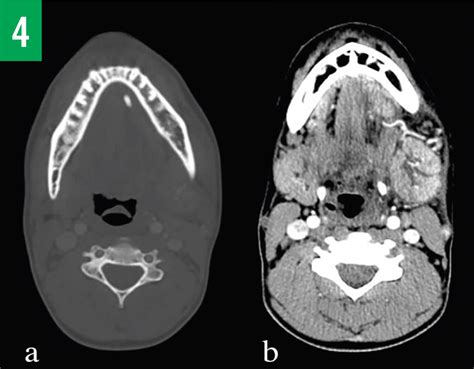 Ultrasound Diagnosis Of Sialolithiasis In A Patient With Jaw Pain And