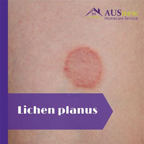 what is lichen planus causes symptoms and treatment lichen planus treatment artofit