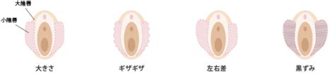 小陰唇縮小術のメリットとデメリットについてリスクとともに解説 Wクリニック福岡院 美容皮膚科・美容外科・美容内科