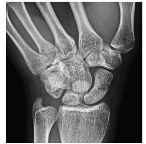 Scaphoid View Radiograph Of The Left Wrist In A Gymnast