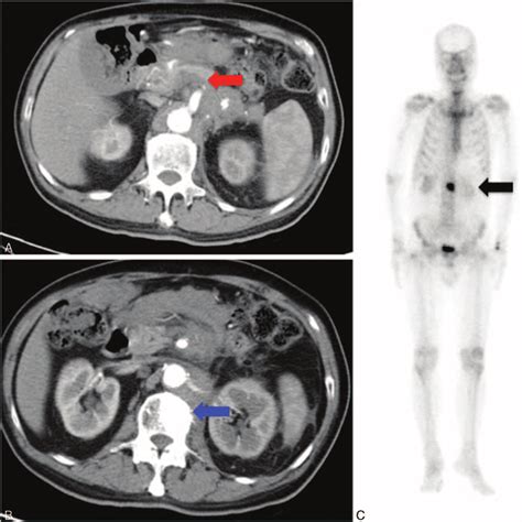 A Abdominal Ct With Contrast Showing An Ill Defined Mass In The