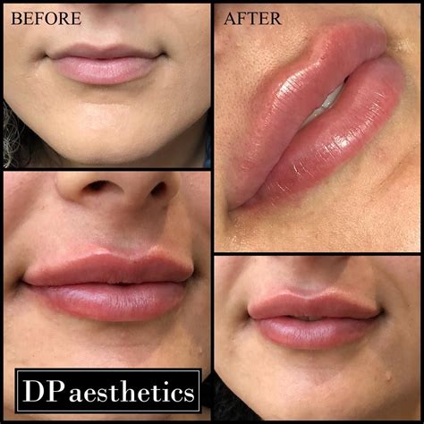 lip filler before and after natural before and after