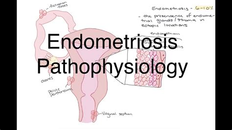Endometriosis Pathophysiology Youtube