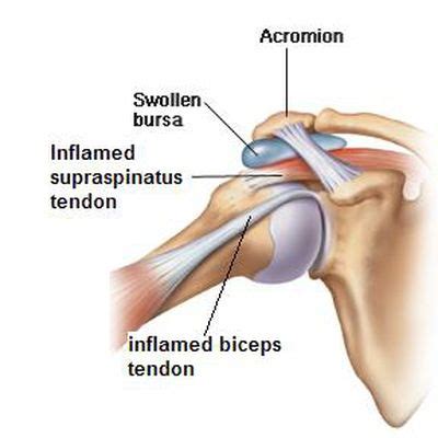 They act as a cushion between moving parts in the joint to stop muscles, bones, and tendons from rubbing together. Image result for supraspinatus tendinosis | Shoulder tendonitis, Bursitis shoulder ...