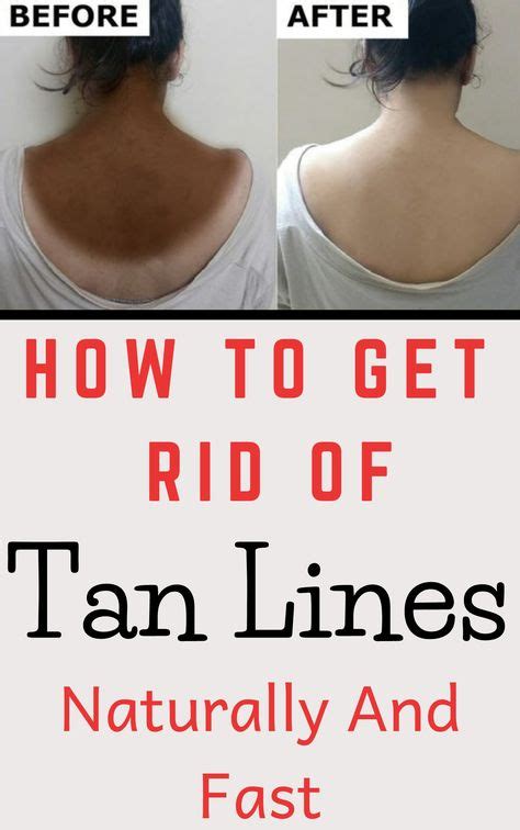 How To Get Rid Of Tan Lines Naturally And Fast Tan Lines Skin Tan