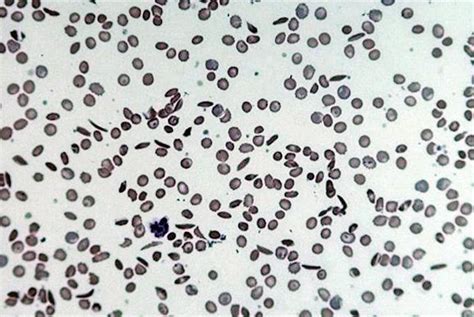 Sickle Cell Anaemia Gponline