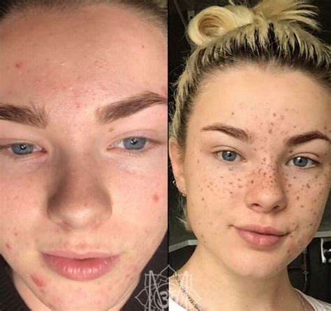 Fake Freckles Beauty Trend Sees Young Girls Tattoo Their Face Express