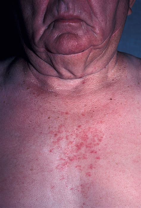 Seborrheic Dermatitis On Chest Pictures Photos