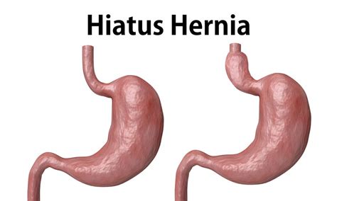 Hiatal Hernia Overview Causes Symptoms Treatment