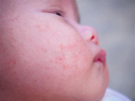 Baby With Dermatitis Problem Of Rash Allergy Suffering From Food