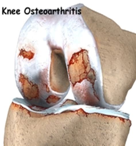 Knee Osteoarthritis Brisbane Knee And Shoulder Clinic Dr