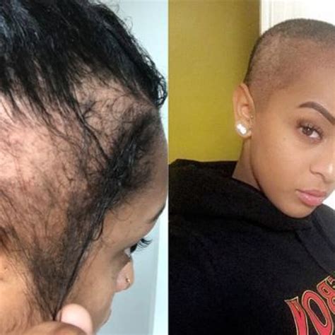 List 92 Images Alopecia In Black Females Pictures Excellent 112023