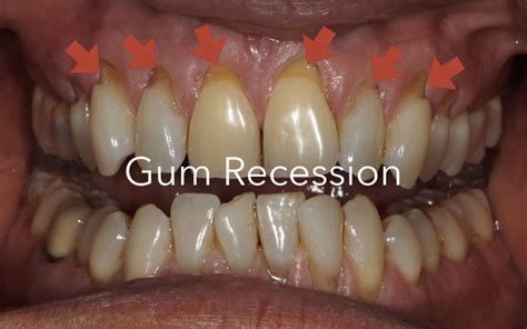 What Causes Gum Recession Causes Prevention And Treatments