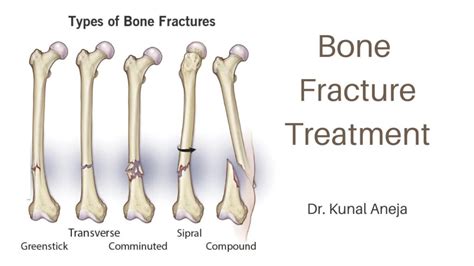 Bone Fracture Treatment Dr Kunal Aneja