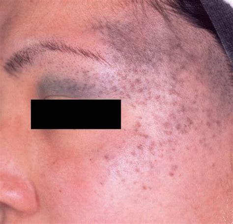Pigmented Lesions Fountain Of Youth Medi Spa