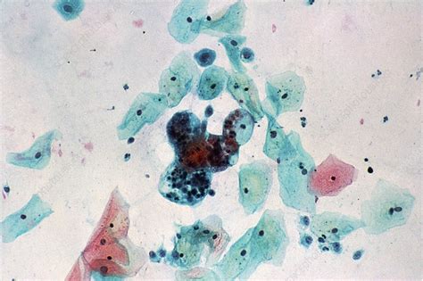 Lm Of Cervical Smear Showing Adenocarcinoma Stock Image M8500297