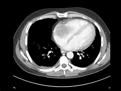 Burkitts Lymphoma Ct Wikidoc