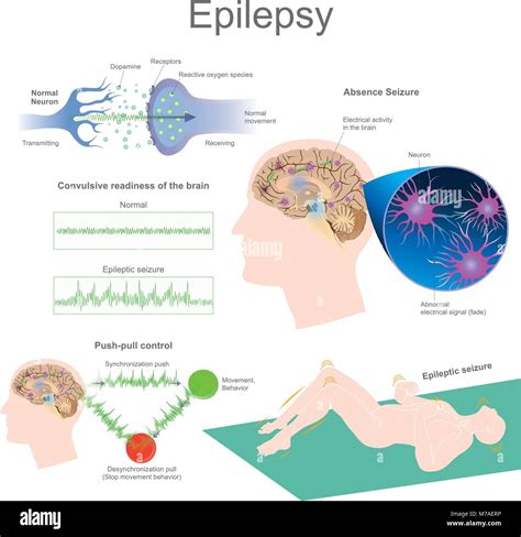 Epilepsie Ist Eine Gruppe Von Neurologischen Störungen Durch