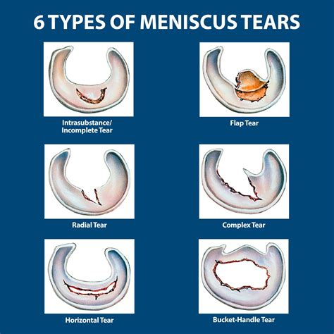 Meniscus Tears Florida Orthopaedic Institute Free Nude Porn Photos