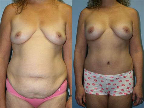 Mommy Makeover Before After Photo Gallery Downers Grove IL Dr