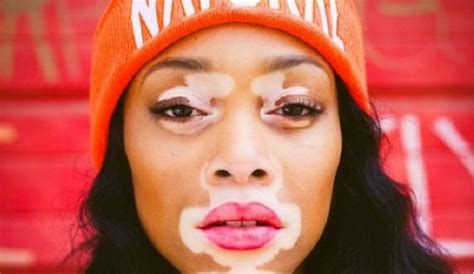 Here Is Chantelle Brown Young With Her Unconventional Beauty Vitiligo