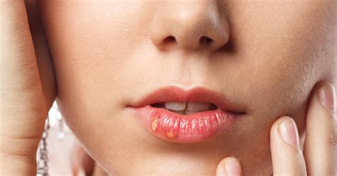 Itchy Small Red And White Bumps On Lips Reasons And Treatment