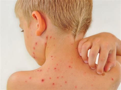 Identify And Treat Your Childs Rash