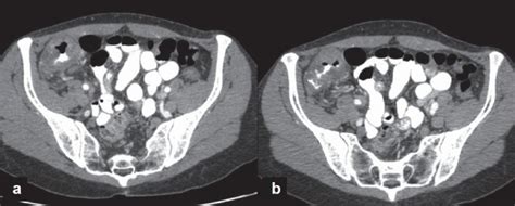 A Ct Scan Of The Abdomen And Pelvis With Intravenous And Oral