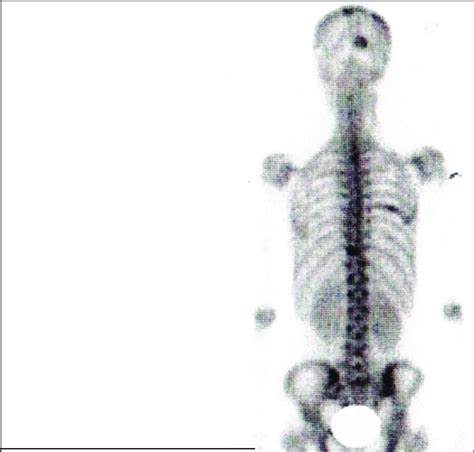 Bone Scan Showing Mets In Skull Download Scientific Diagram