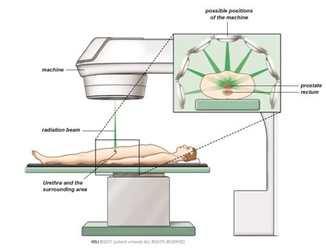 Radiation Therapy Diagram