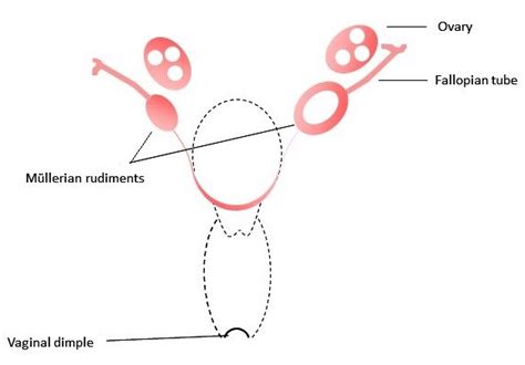 mrkh syndrome utero vaginal aplasia class u5 c4 v4 of the eshre esge download scientific