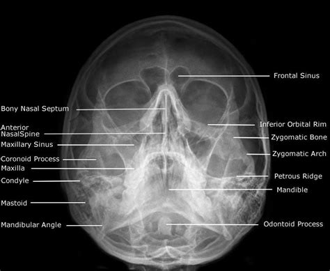 Ap axial skull ( townes projection ). Waters skull | Facial bones, Radiology, Nuclear medicine