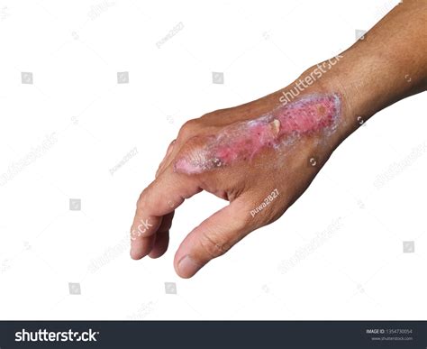 Hand Wounds Caused By Accidents Stock Photo 1354730054 Shutterstock