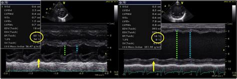 M Mode Echocardiography From A Parasternal Short Axis View Showing