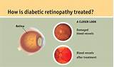 Pictures of Laser Eye Treatment For Diabetics
