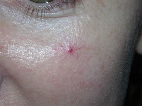 Spider Angioma Causes Symptoms Diagnosis And Spider Angioma Treatment