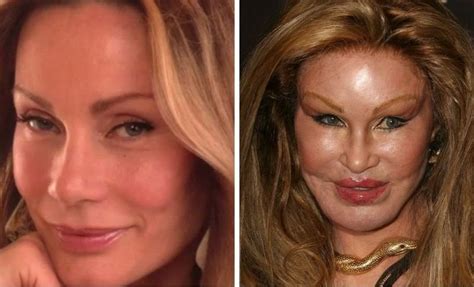 Celeb Plastic Surgery Gone Wrong 20 Worst Cases Of Celebrity Plastic