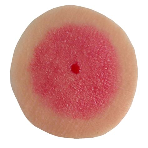 Simulaids Ulcer Stage 1 Is A Look Alike Of The Real Ulcer With A Skin