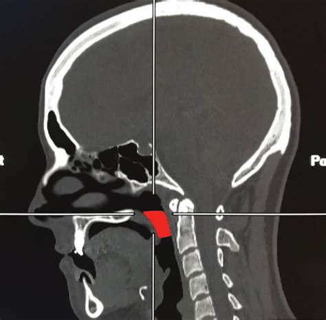Sagittal View Of The Nasopharyngeal Volume Assessed Download