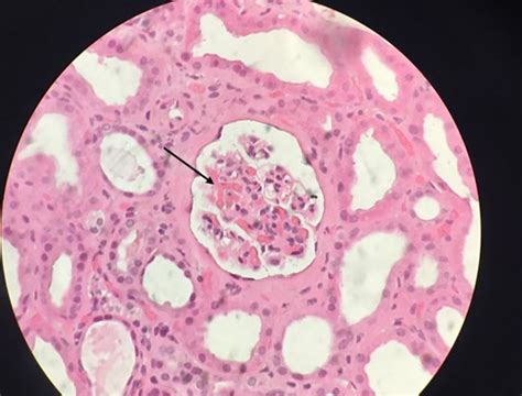 Atypical Haemolytic Uremic Syndrome From Multiple Missenses To A Full