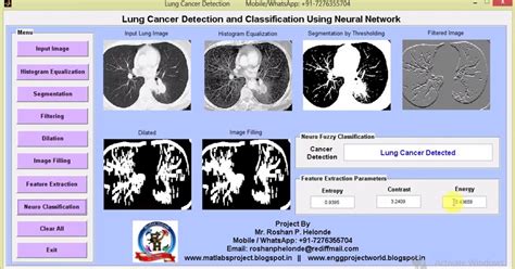 Lung Cancer Detection Using Neural Network Matlab Project With Source