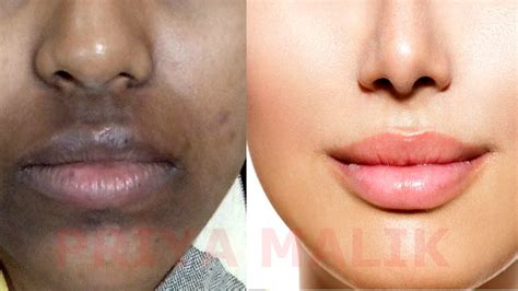 How To Remove Dark Skin Near Lips