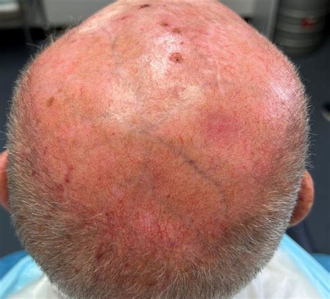 Early Squamous Cell Carcinoma Scalp