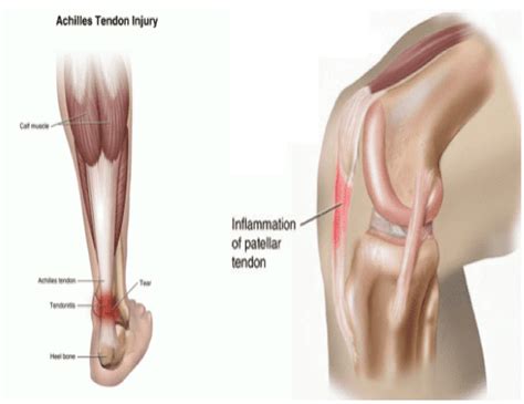 How long does it take for collagen to work for joint pain. When Will My Injuries Heal? | Symmetry Physical Therapy ...