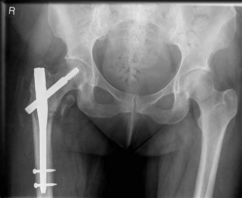Intertrochanteric Hip Fracture With Fixation Device Fracture My Xxx Hot Girl
