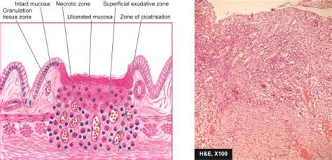 Gastric Ulcer Histology