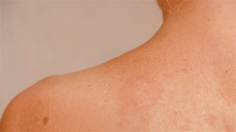 Pityriasis Rocea Symptoms Causes Treatment Toronto Dermatology