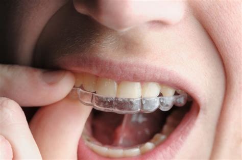 Fort Worth Tx Invisalign Becomes An Orthodontic Treatment Of Choice